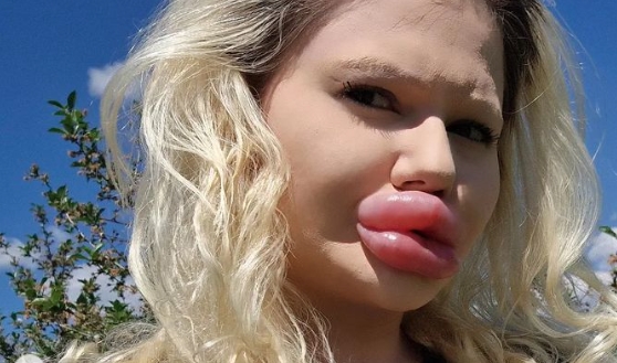 „Ги имам најголемите усни на светот, но направив нов зафат“:  Андреа му дала милиони на пластичниот хирург и не планира да запре  (фото)